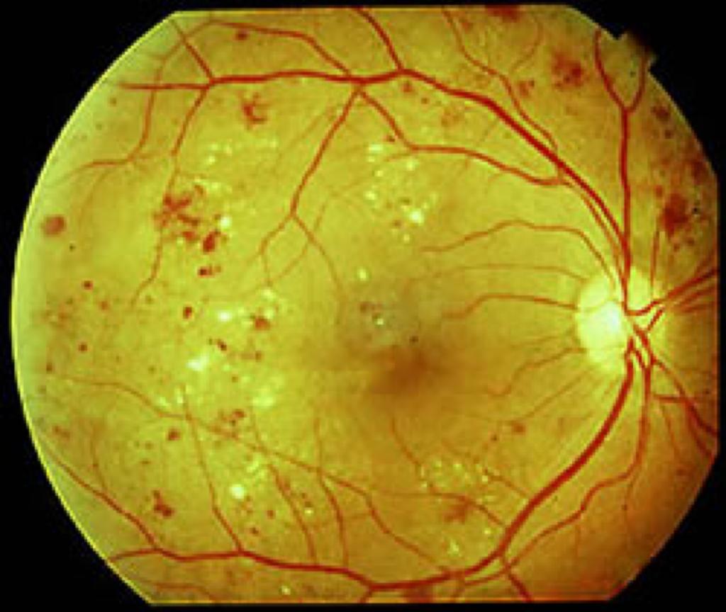 Сетчатки обоих глаз. Ангиопатия сосудов сетчатки. Диабетическая микроангиопатия (ретинопатия.